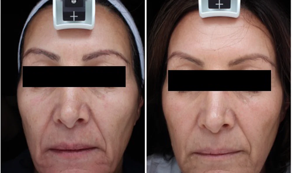 LaseMD ULTRA — фото до и после, омоложение кожи, курс 3 процедуры