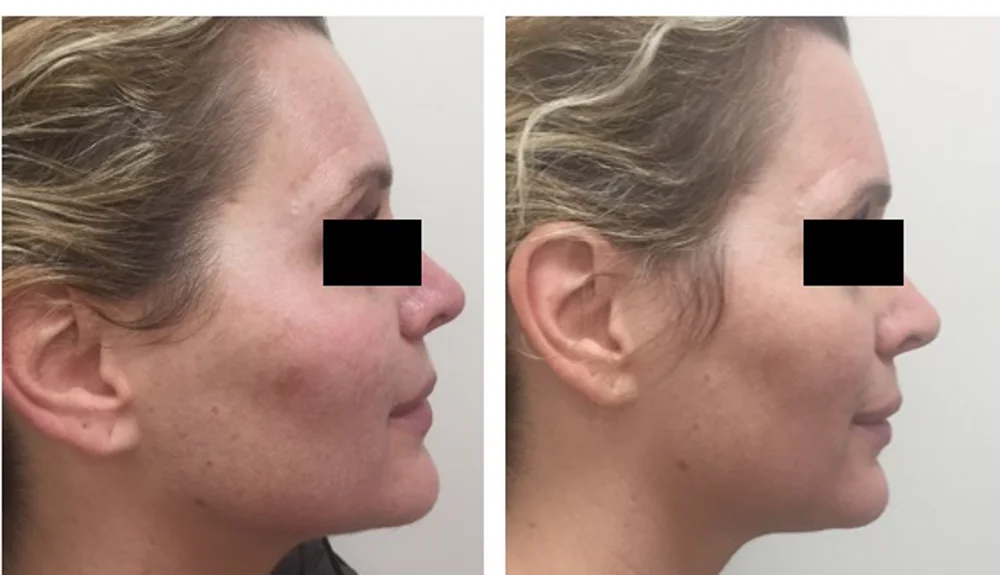 LaseMD ULTRA — фото до и после, коррекция пигментации, курс 2 процедуры