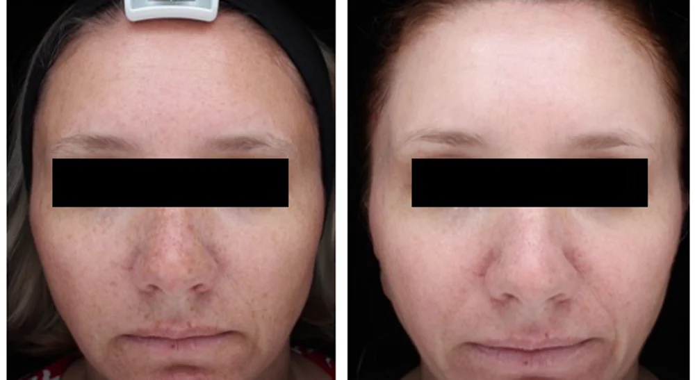 LaseMD ULTRA — фото до и после, коррекция пигментации, курс 3 процедуры